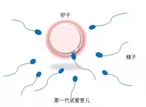 第三代试管婴儿
